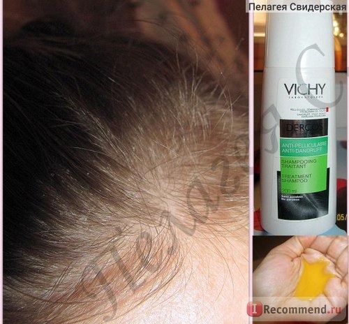 Интенсивный шампунь-уход Vichy DERCOS против перхоти для жирных волос фото