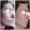 Гель-крем для лица La Roche Posay Effaclar DUO[+] фото