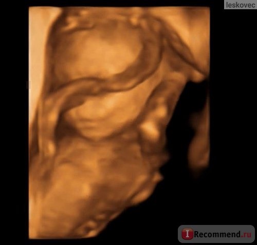 4D УЗИ во время беременности фото