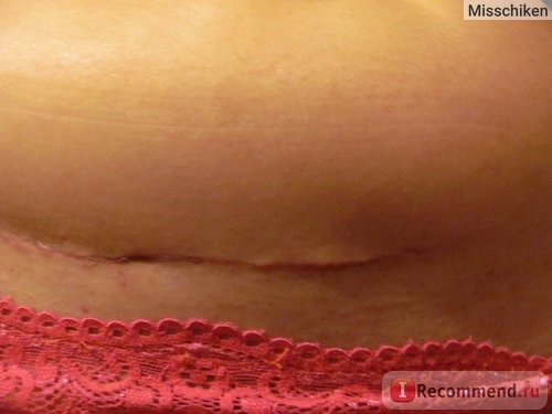 Операция по удалению миомы матки - лапаратомия фото