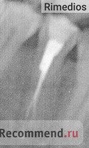 28-й зуб. Вокруг корня потемнение - это признак некачественной пломбировки каналов. Паста (белое вещество на снимке) вытекла за пределы корня