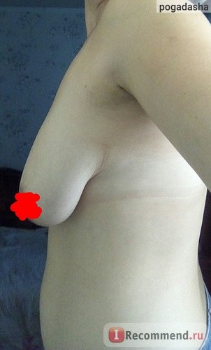 Мастопексия (подтяжка) груди фото