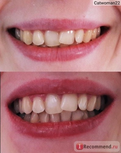 Косметологическое отбеливание зубов Magic White фото