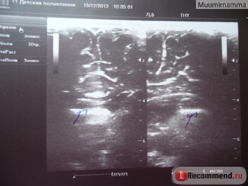 Нейросонография (УЗИ головного мозга).