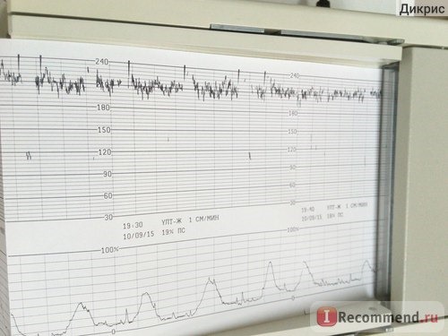 ктг: 200-230 ударов в минуту